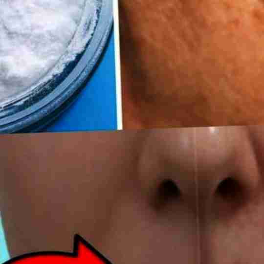 Baking soda can help get rid of age spots, acne, and blackheads! This is what you should do